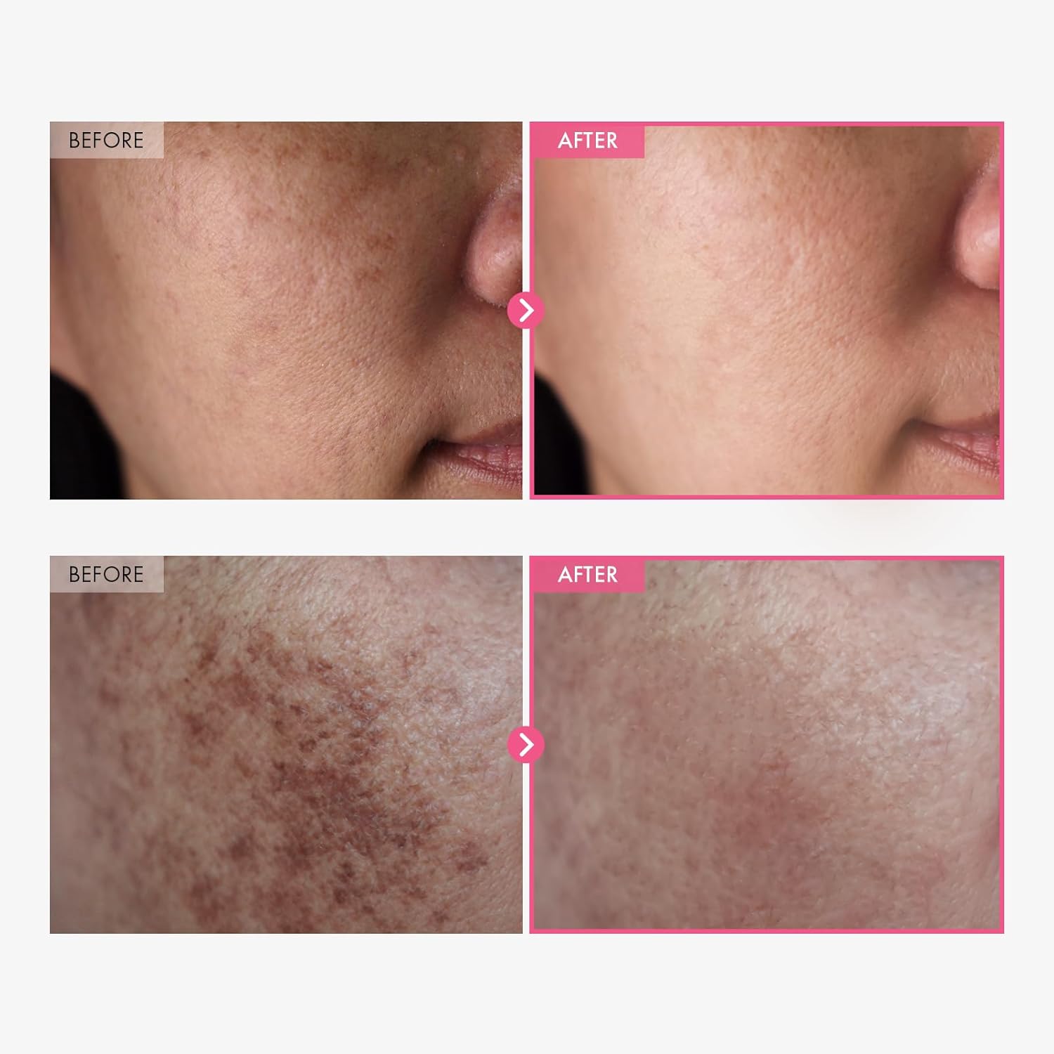 TOSOWOONG Arbutin 7% + Tranexamic Acid 4% Cream
